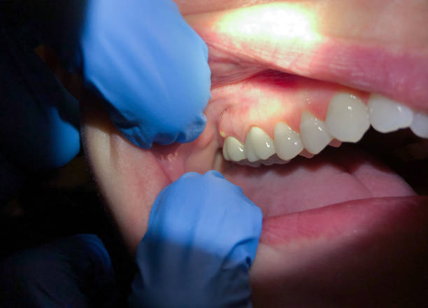 Best Dentist for Tooth Abscess  in Richmond, IN